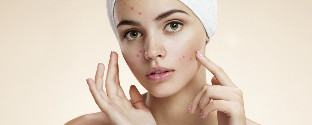 women_with_acne_2048x